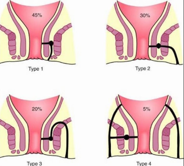 Anal Fistula Plug For Fistula In Ano - Best Minimally Invasive Procedure
